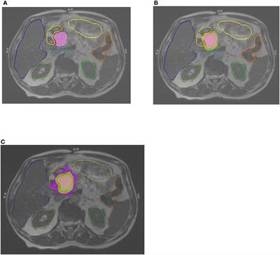 Pancreatic cancer outcome—local treatment with radiation using MRI-LINAC